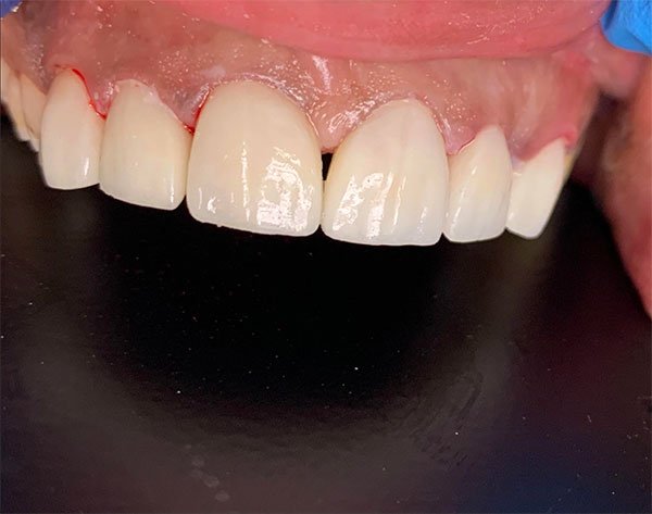 After: Veneers and crowns combination