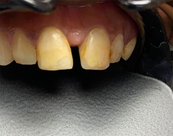 Before: Veneers and crowns combination