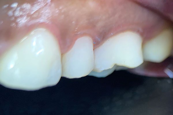 After: Composite restoration