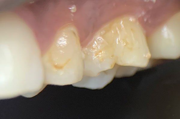 Before: Composite restoration