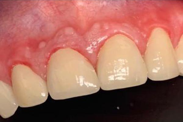 After: Veneers, implants and crowns
