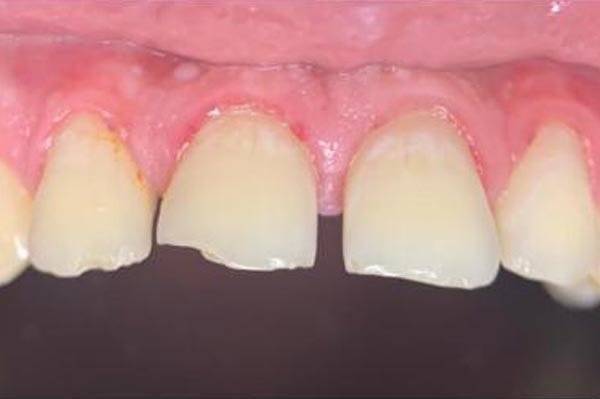 Before: Veneers, implants and crowns
