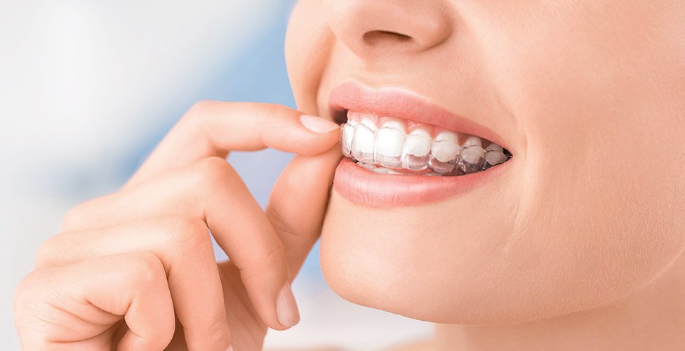 Orthodontics and Invisalign